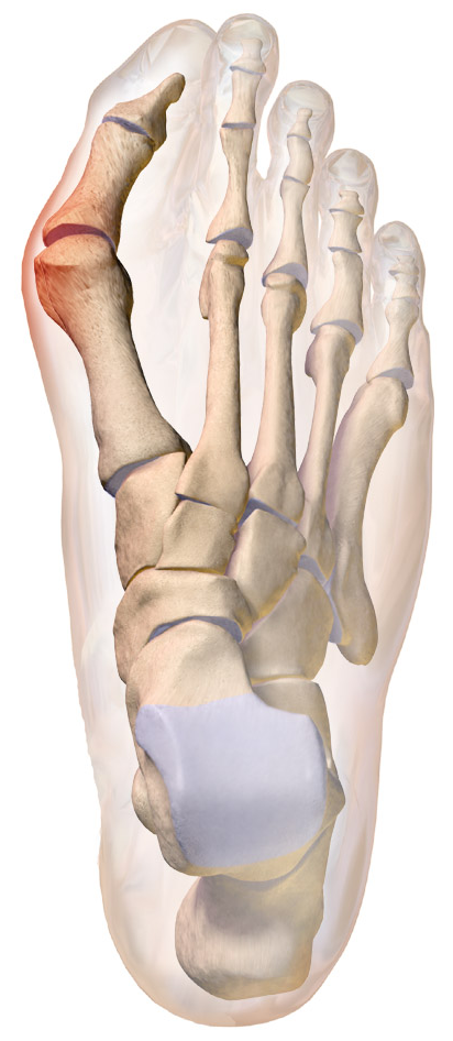 Figure 2: Valgus, Hallux Valgus. License to limp. Relationship status: It&rsquo;s complicated.